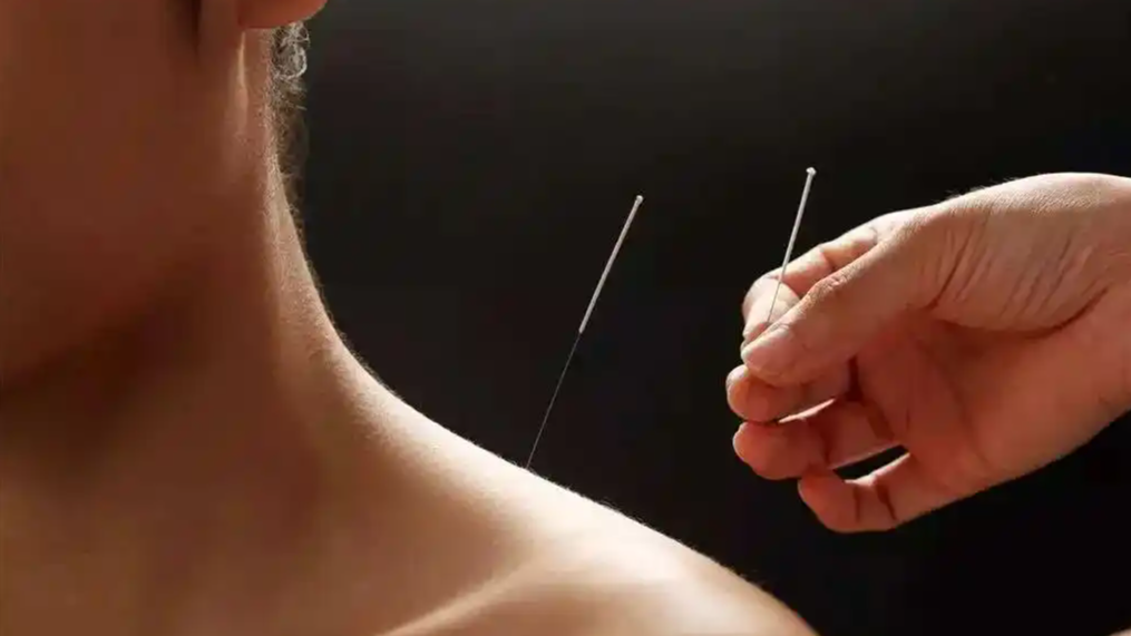 2000年前古人如何做针灸