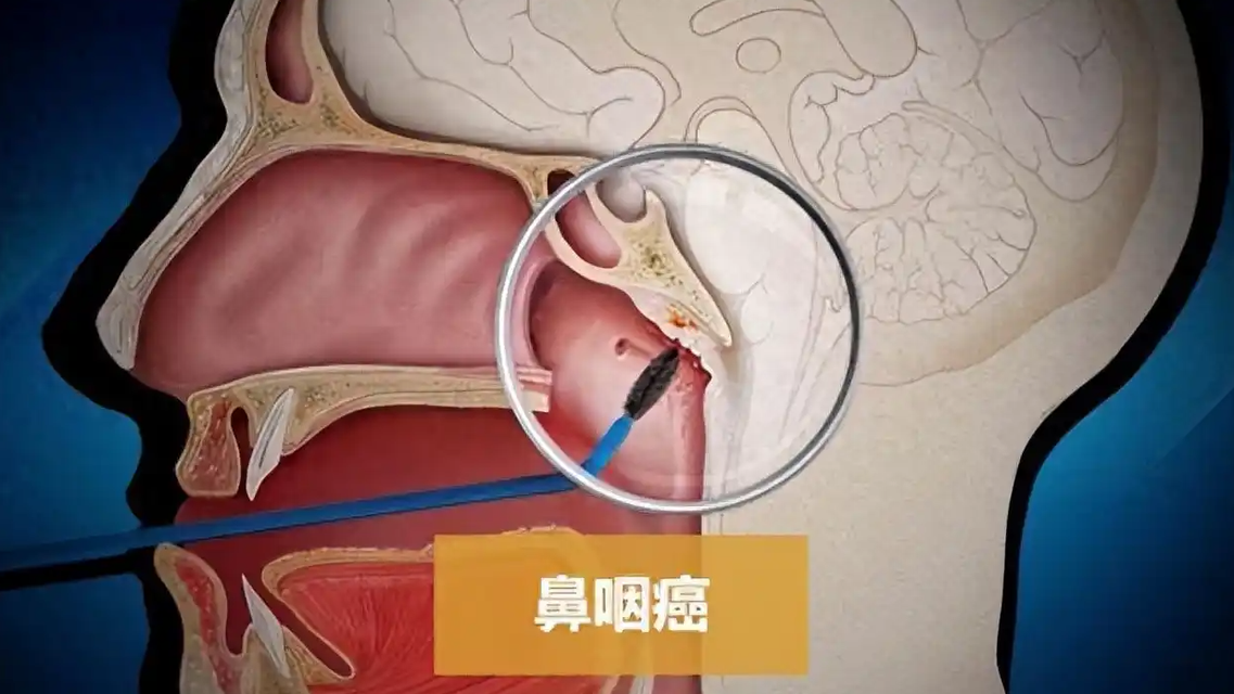 鼻咽癌治疗又有新突破
