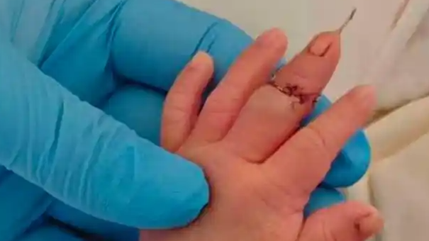 新生儿剪脐带时疑被助产士剪断手指