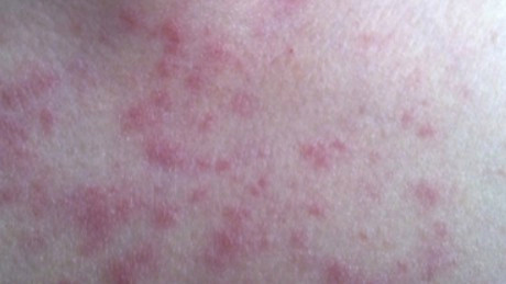 女子患红斑狼疮 为备孕停药突发昏迷