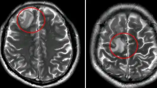 34岁男子两天汗蒸三次诱发脑血栓