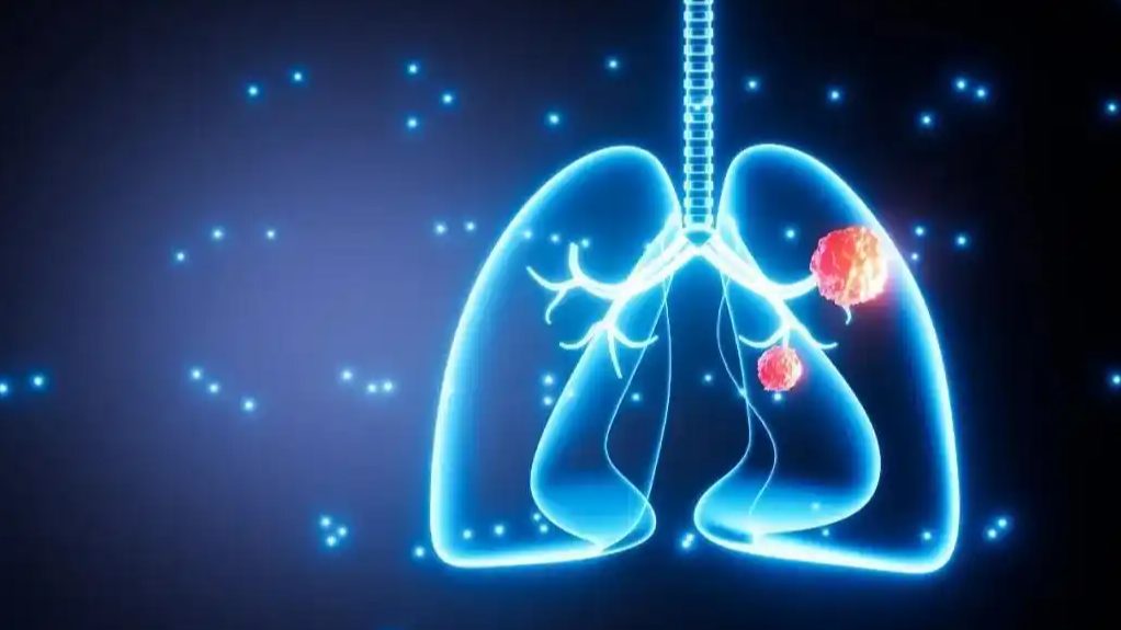 肺癌成中国女性第一大癌症